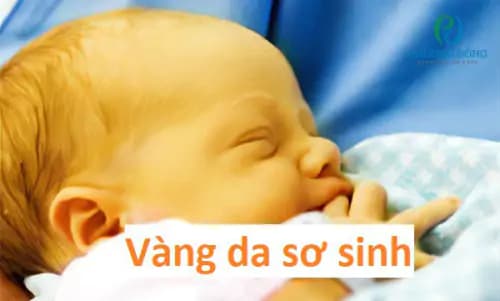 Vàng da do tăng bilirubin gián tiếp